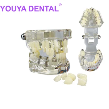 Zobu Nervu Remonts Modelis Bērnības Lapu Pastāvīgo Zobu Patoloģijas Modelis ar Zobārstu Studentiem Saziņas un Mācību R