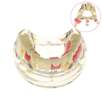 Zobu Zobu Modelis Ar Implantu Tiltu Un Kariesa Mācību Zobu Modeļus, Zobārsts, Ārstēšana, Implantācija, Demo Sveķi Modeļa